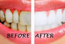 Top 11 Cách làm đẹp răng tự nhiên, trắng sáng hiệu quả nhất