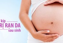 Top 7 Bí quyết xóa rạn da khi mang thai bằng chanh