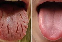 Top 8 Màu lưỡi bất thường báo hiệu cơ thể bạn mắc bệnh lý từ lâu