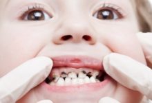 Top 9 Cách chữa sâu răng đơn giản và triệt để nhất