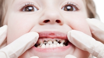 Top 9 Cách chữa sâu răng đơn giản và triệt để nhất