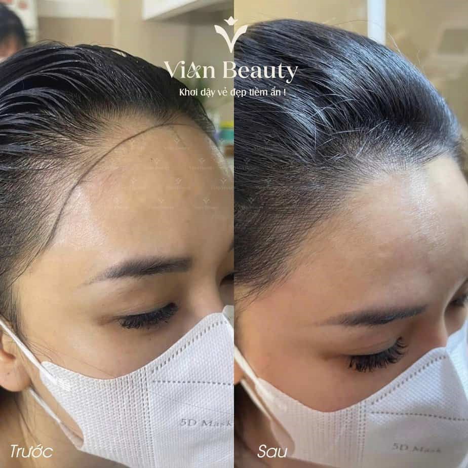 Điêu Khắc Chân Tóc Nam, Nữ tại Vian Beauty Giá Bao Nhiêu, Tốt Không? 5