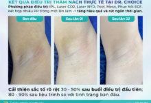 Dr. Choice Clinic – Địa Chỉ Trị Thâm Nách, Bẹn Uy Tín và Hiệu Quả Tại TP.HCM 3