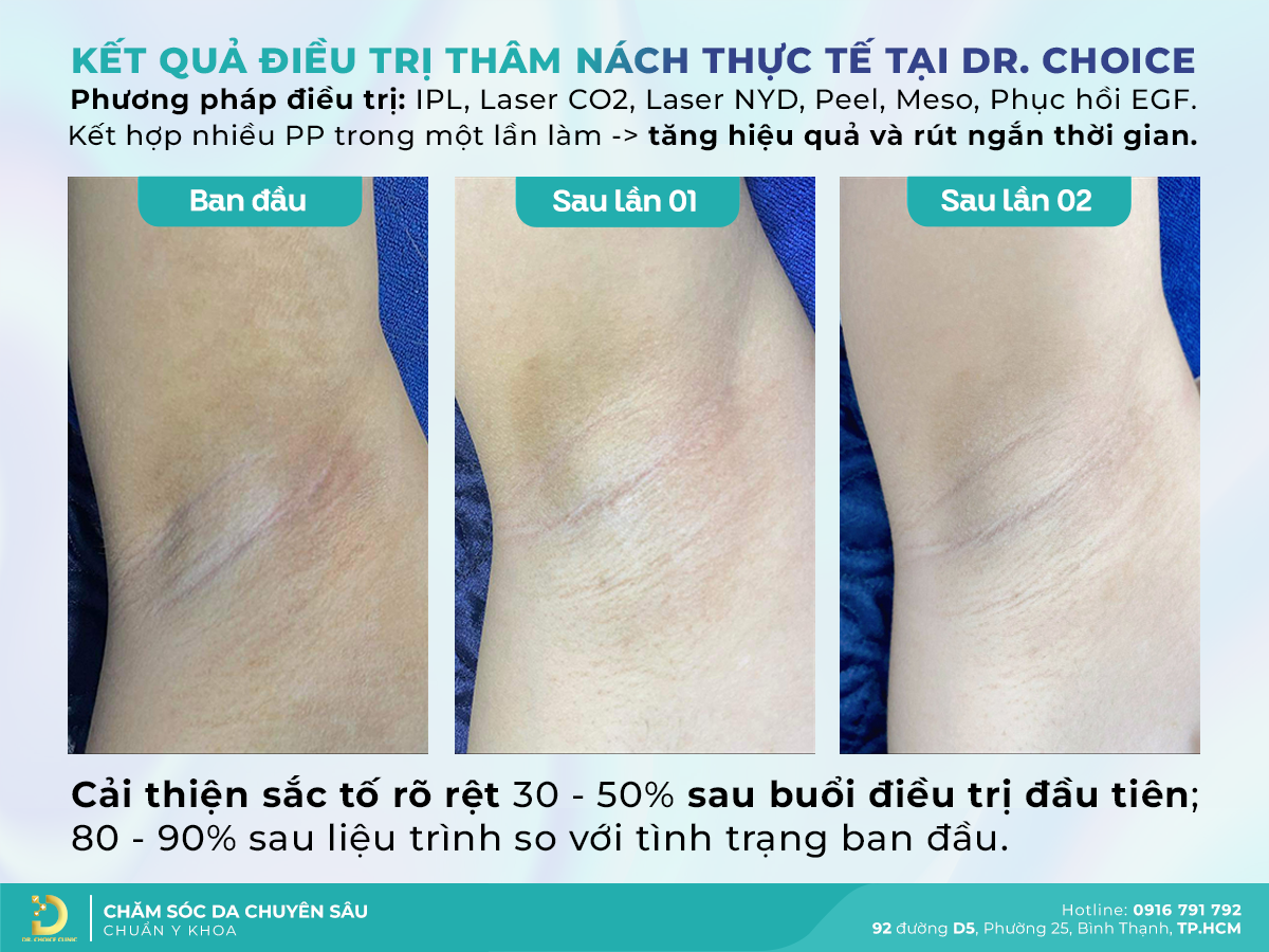 Dr. Choice Clinic – Địa Chỉ Trị Thâm Nách, Bẹn Uy Tín và Hiệu Quả Tại TP.HCM 1